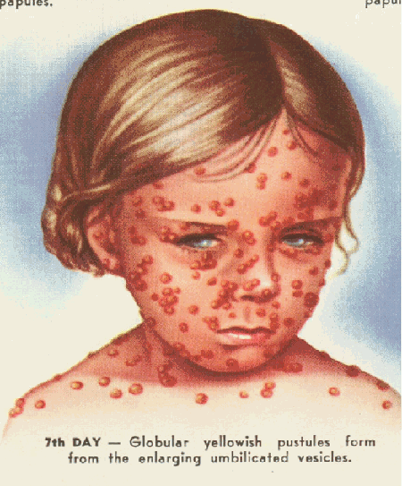 start of chickenpox #10