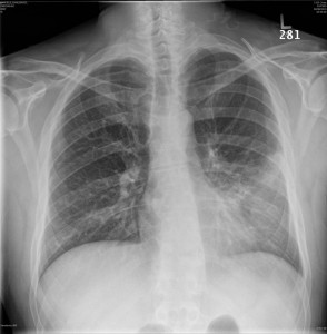 lingular_pneumonia_PA.sized