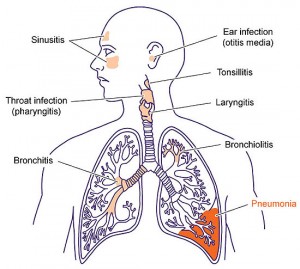 rti-pneumonia