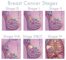 How many stages of cancer are there?