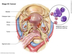 staging-ovarian-cancer-07